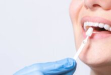Dental-Implants