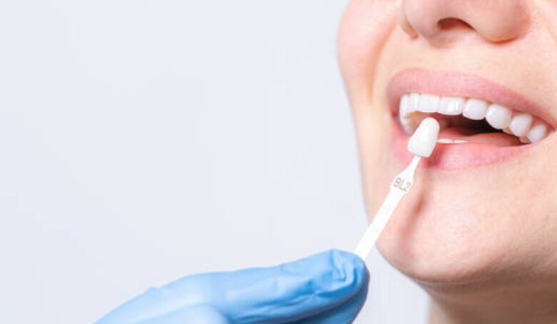 Dental-Implants